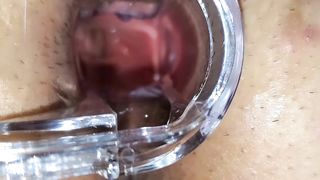 BBW Extreme Anal and Asshole Speculum Gape - 10 image